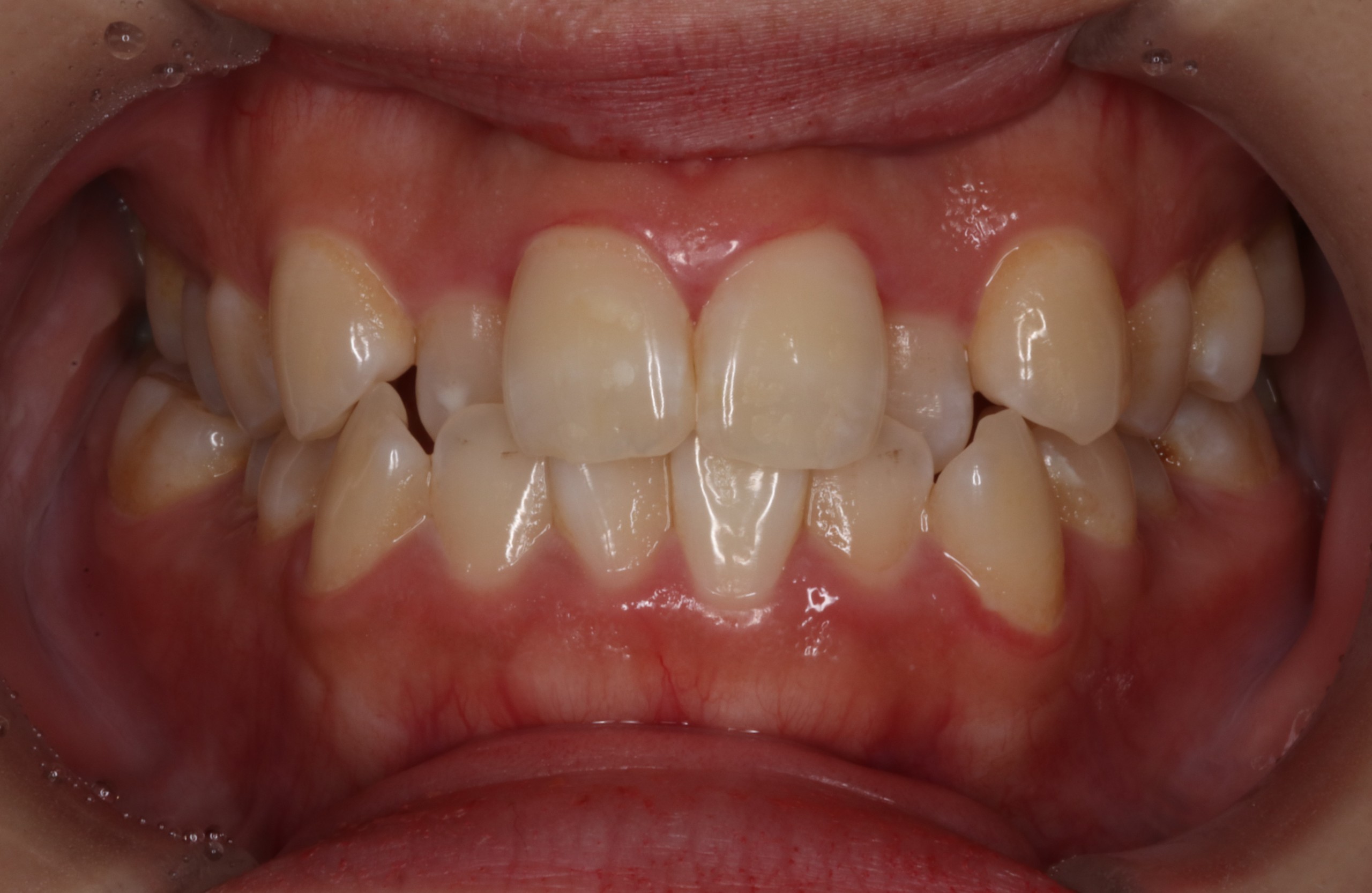 叢生・ハーフリンガル矯正の矯正