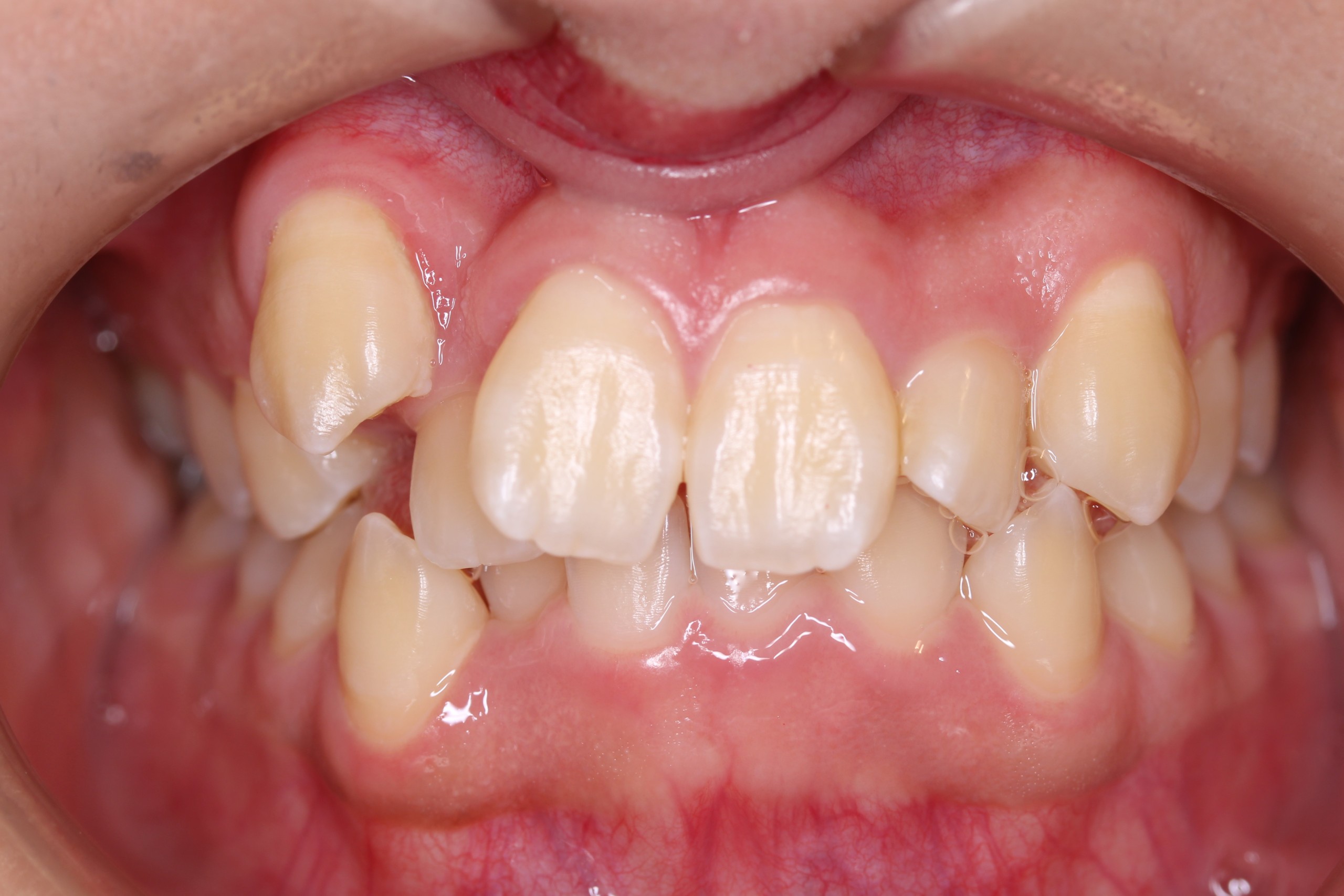 八重歯・叢生・ハーフリンガルの症例