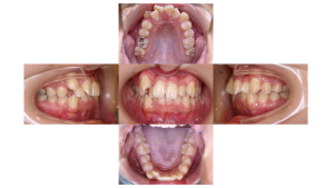 上顎前突・叢生・ハーフリンガルの症例