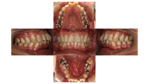 叢生・裏側矯正の症例