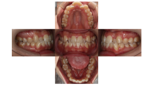 叢生・ハーフリンガル矯正の矯正