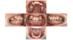 上顎前突・叢生・ハーフリンガルの症例