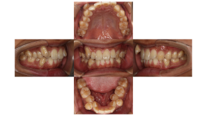 叢生・ハーフリンガル矯正の症例