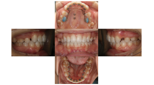 叢生・裏側矯正の症例