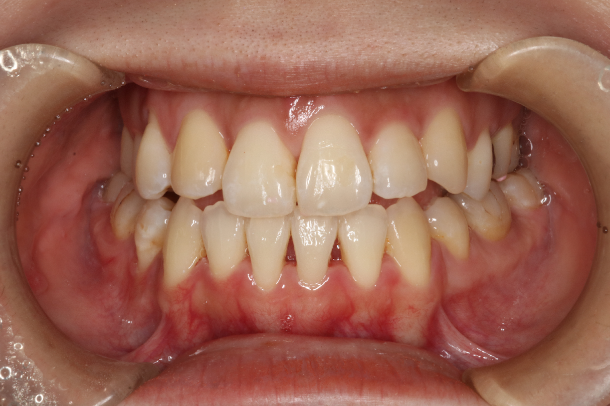 叢生・ハーフリンガル矯正の症例