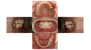 叢生・ハーフリンガル矯正の症例