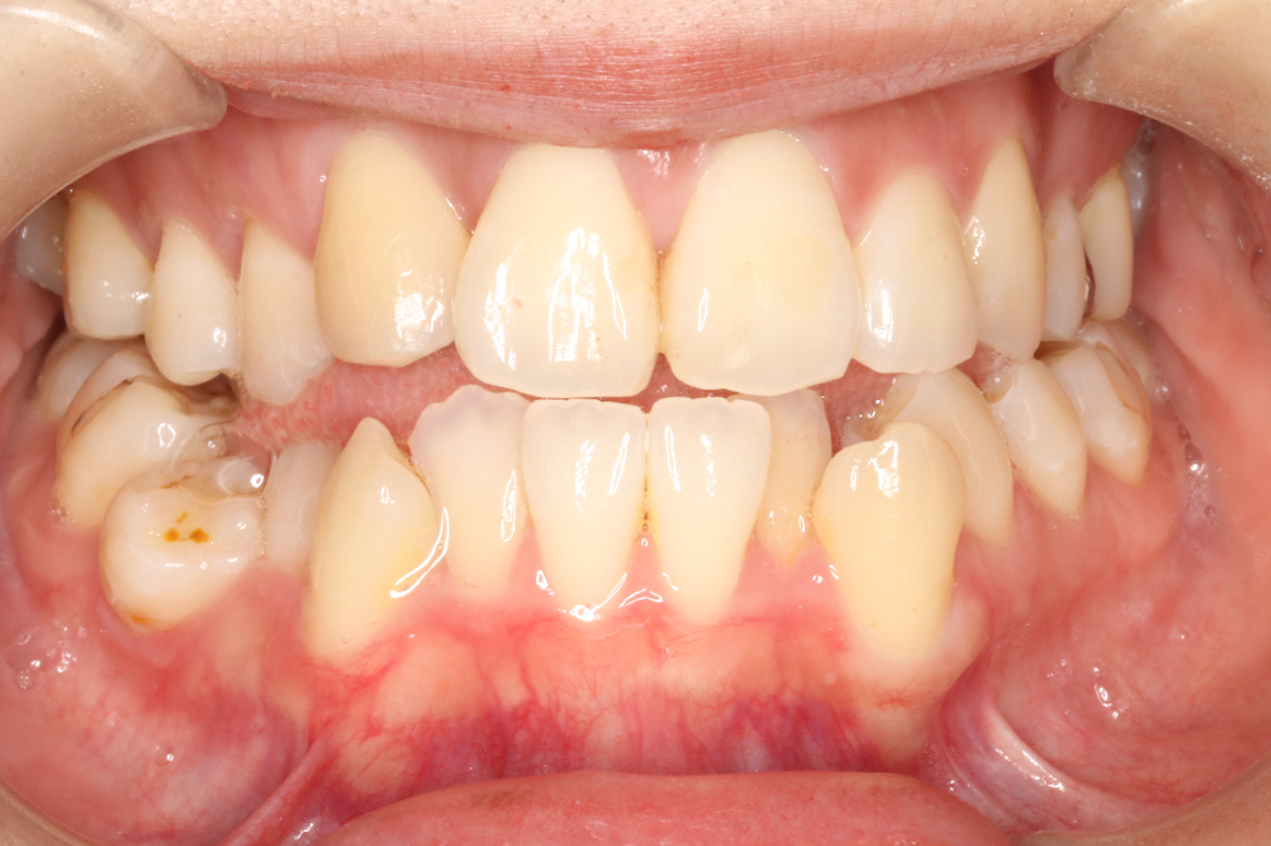 叢生・ハーフリンガル矯正の症例