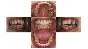 叢生・ハーフリンガル矯正の症例