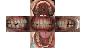 上顎前突・叢生・リンガルの症例