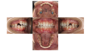 叢生・裏側矯正の症例