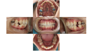 上顎前突・叢生・リンガルの症例