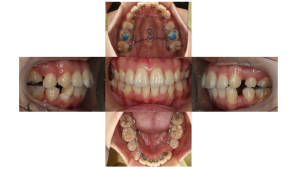 上顎前突・叢生・リンガルの症例