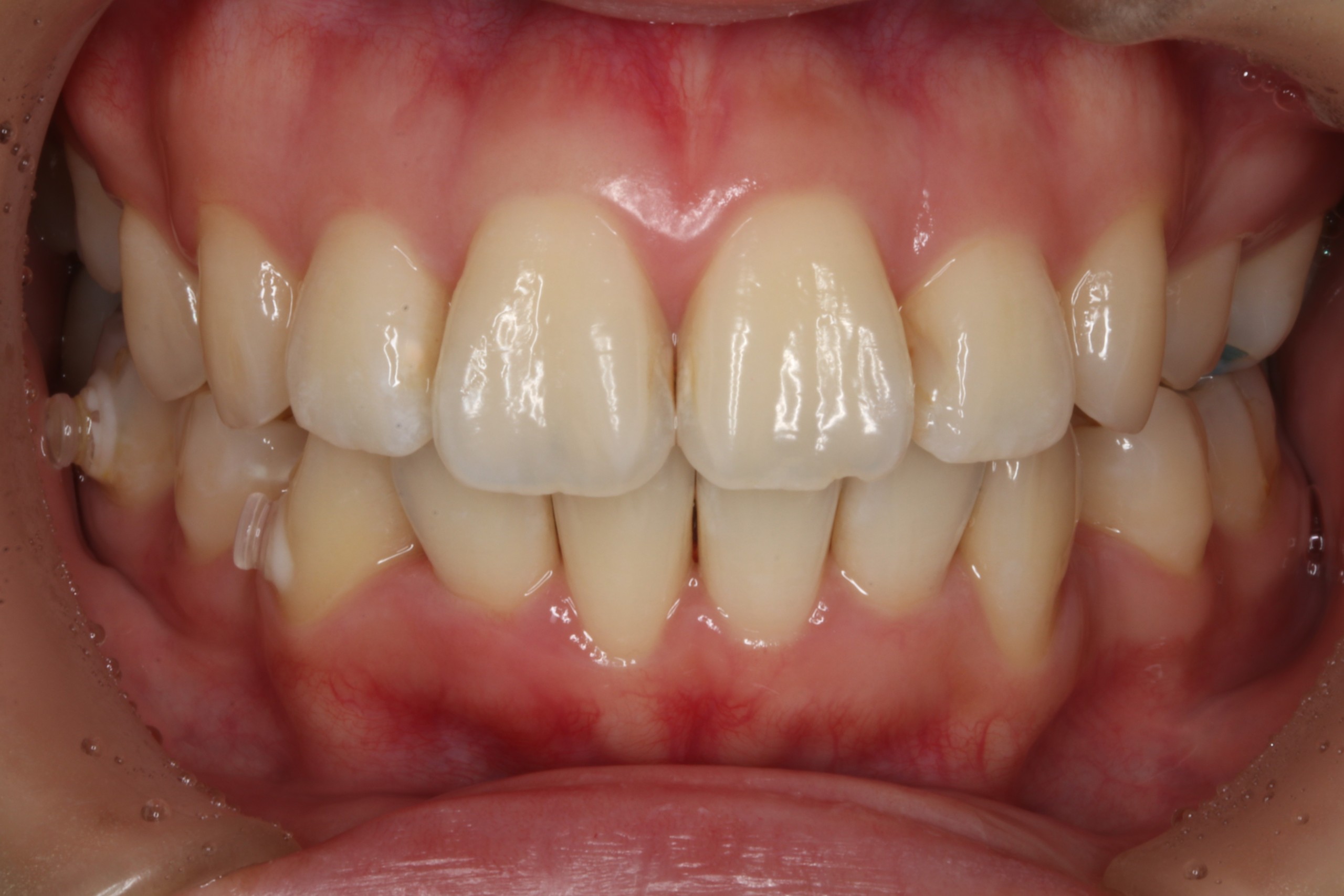 上顎前突・叢生・リンガルの症例