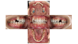 叢生・裏側矯正の症例