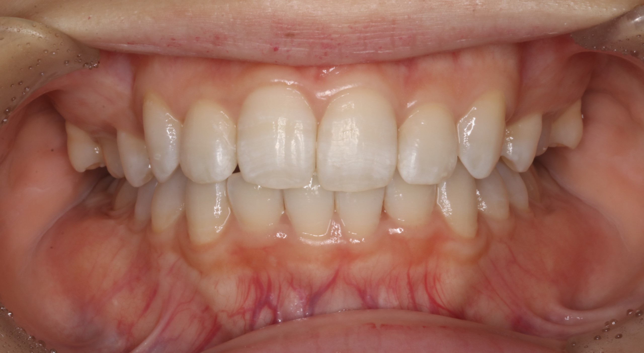 叢生・裏側矯正の症例