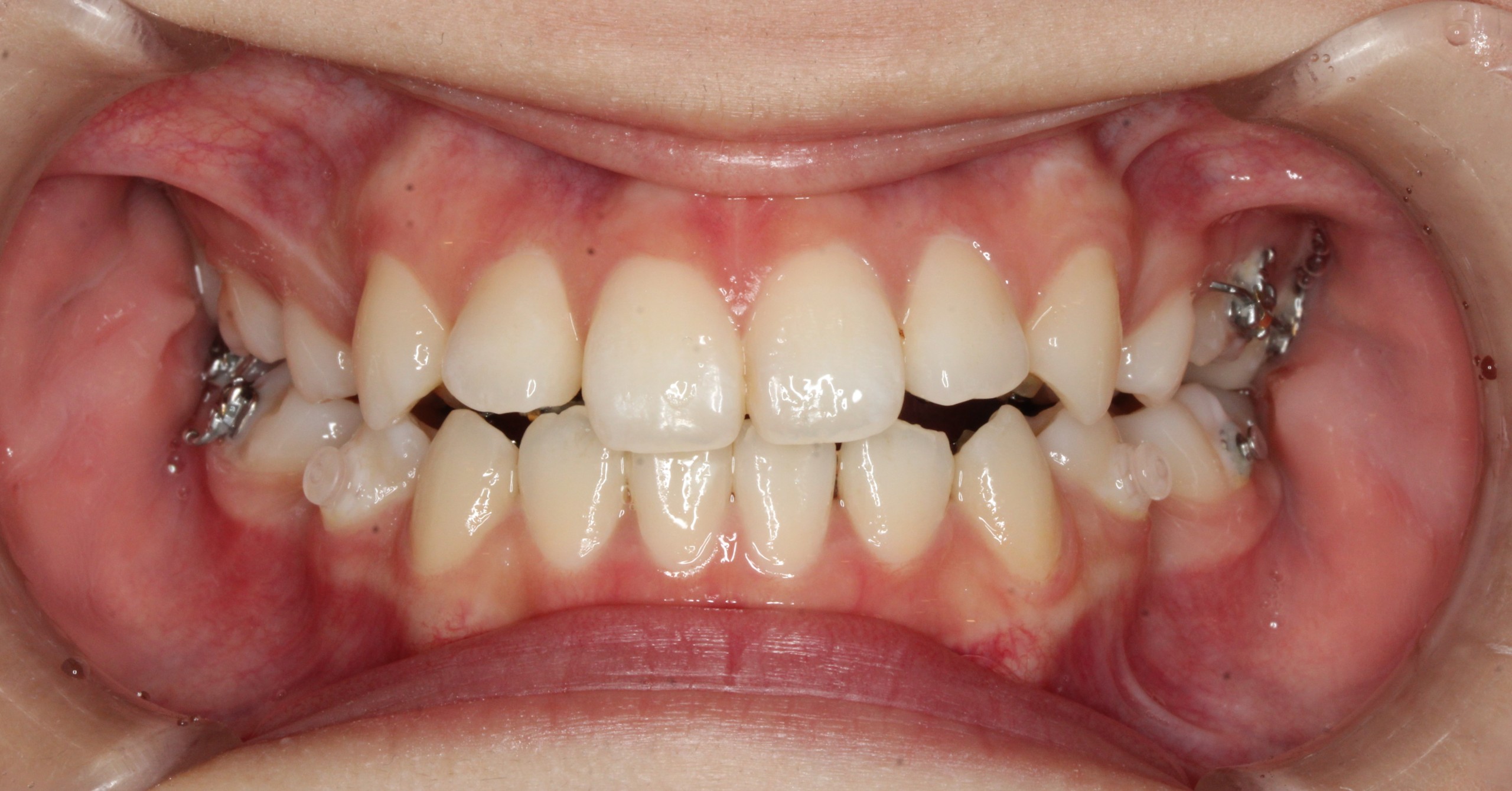 叢生・裏側矯正の症例