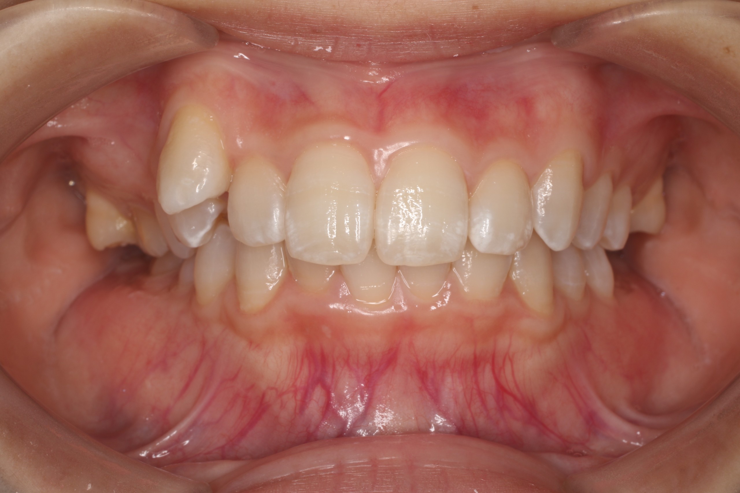 叢生・裏側矯正の症例