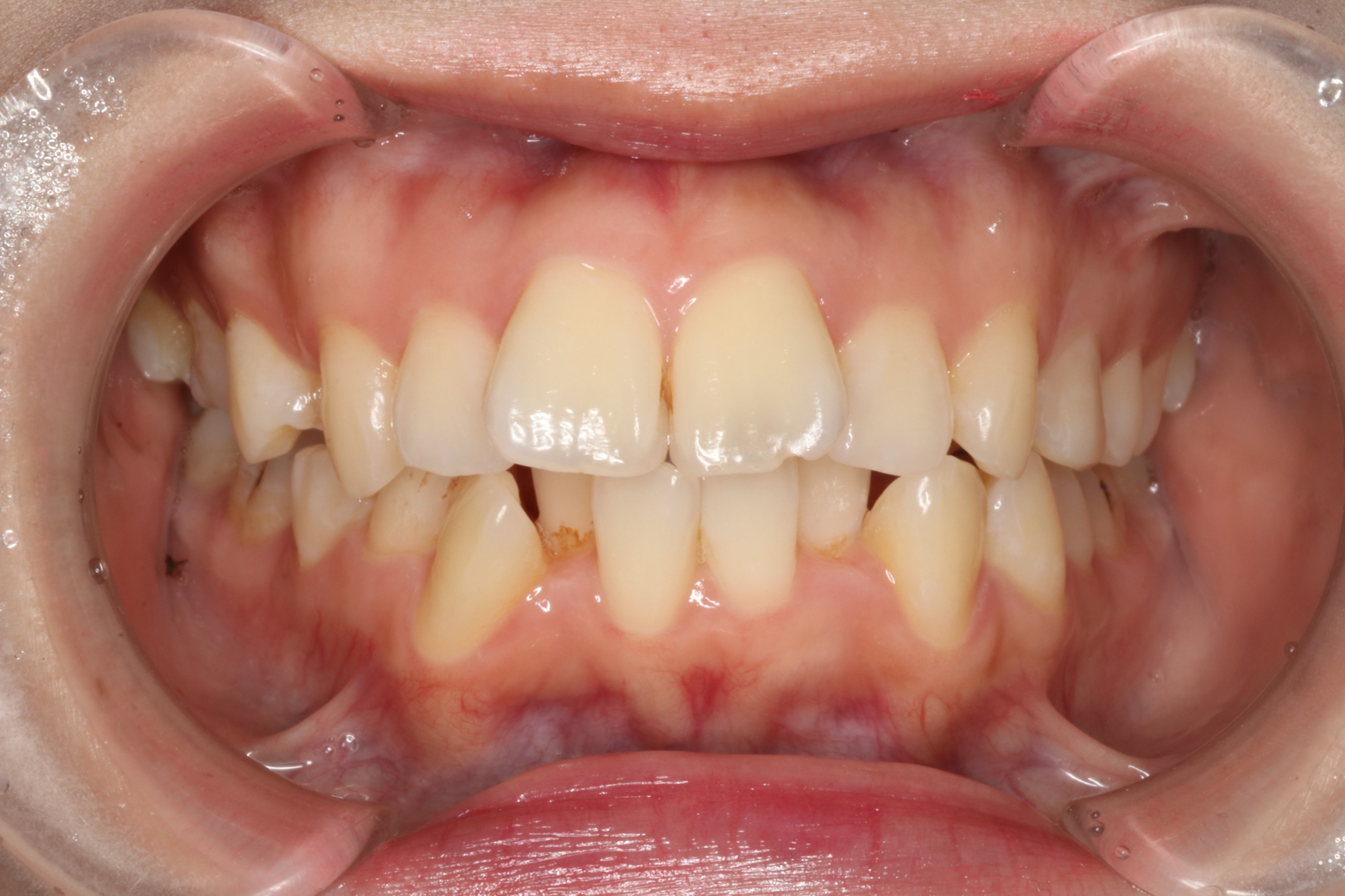 上顎前突・叢生・リンガルの症例