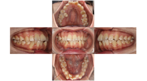 上顎前突・叢生・リンガルの症例