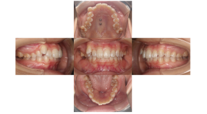 叢生・裏側矯正の症例