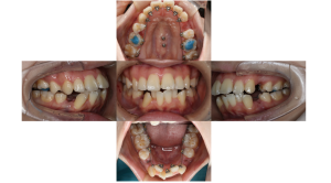 上顎前突・叢生・リンガルの症例