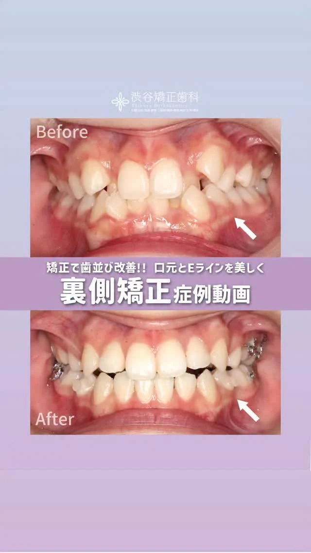 詳細は【続きを読む】をタップ☝️
皆さんこんにちは😄渋谷矯正歯科です🦷✨  今回は【ハーフリンガル矯正】の症例紹介です👏  🤔主訴：全体的な歯並びの凹
🧑🏻年齢・性別 ：20代・女性
💉治療に用いた矯正装置：裏側矯正(リンガル矯正)
🦷抜歯部位：上下左右の小臼歯を抜歯し、矯正治療を開始
🏥治療期間と初診からの通院回数：2年～(現在治療中)
⚠️リスク・副作用：歯の動きに伴う痛み  当院は
💎裏側矯正
💎ハーフリンガル矯正
💎表側矯正
💎マウスピース矯正
での治療も可能です。  患者様の経過が目で見てわかる最新の3Dシミュレーションで精密検査し、最適の治療をご提案しております🦷  ✅バレずに歯並びを綺麗にしたい方、
✅お仕事しながらバレずに矯正したい方
✅学校に通いながらバレずに矯正がしたい方
✅歯並びでお悩みの方  そんなあなたにオススメしたい歯列矯正です！
少しでも気になりましたら
無料カウンセリングにお越しください✨️  矯正をするなら渋谷矯正歯科にお任せあれ🫶  当院では、患者様のお悩みに沿って
最適な治療方法をご提案させていただきます🫧  《営業時間》
平日　12:30ー20:30
土曜　10:00ー18:00  スタッフ一同、心よりお待ちしております🌟
　
《 🔻ご予約方法🔻 》
24時間WEB予約可能!!!📱  ❶プロフィール欄のURLから〈無料カウンセリング〉をTAP!!
❷必要事項を入力し送信すれば予約完了です💌💭
@shibuyakyouseishika  《 ☎️お電話はこちら 》
0120−188−901  駅チカで平日20:30まで営業中
お仕事終わりでも間に合います🌙*.｡
当日予約も大歓迎⭕️  ご予約お待ちしております💐🤍  -———————
#渋谷矯正歯科
#裏側矯正 
#ハーフリンガル矯正 
#口ゴボ矯正 
#受け口矯正 
#すきっ歯矯正 
#口元コンプレックス 
#矯正ビフォーアフター 
#矯正中 
#マスク矯正 
#目立たない矯正
#ワイヤー矯正
#矯正女子