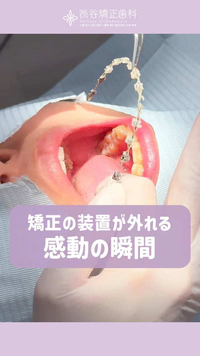 こんにちは！渋谷矯正歯科です🌟  本日のリール動画は歯科衛生士さんに
《 ワイヤー矯正装置を外す瞬間 》を
撮影してきました🦷  長い期間付けることになるので
その分の解放感は凄まじいと思います🪥✨  渋谷矯正歯科は医師も衛生士さんもいつも親身で丁寧✨️
患者様ファーストでご対応してくださってます💞  歯並びでお悩みの方や矯正を検討中の方は
完全無料のカウンセリングへお越しください!!
ご予約お待ちしております💐🤍  —————  《　▼ご予約方法　》
　
24時間WEB予約受付中📱
当日予約可能⭕️
プロフィール欄のリンク先より受け付けております。  ≫ @shibuyakyouseishika  💎カウンセリング完全無料です！
気軽にお越しください。  《TEL》
☎️0120−188−901☎️  《営業時間》
平日　12:30ー20:30
土曜　10:00ー18:00  ————  #渋谷矯正歯科 #渋谷矯正歯科グループ 
#裏側矯正 #表側矯正 #歯列矯正女子 
#マウスピース矯正 #矯正歯科専門 
#歯科衛生士あるある #歯医者あるある #矯正中